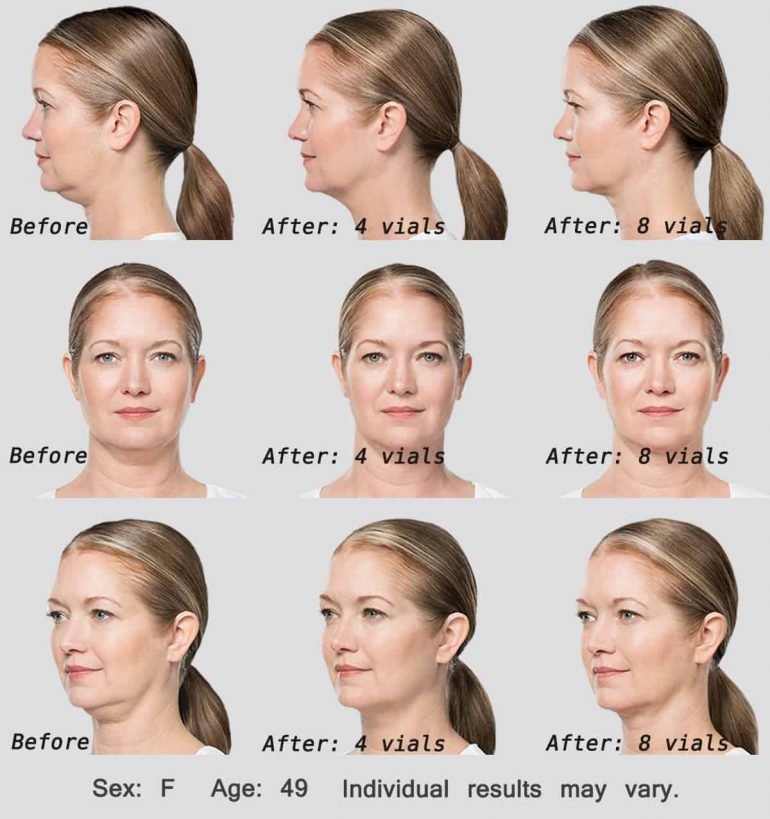 Kybella Cost 2023 Prices List For Double Chin & Reviews