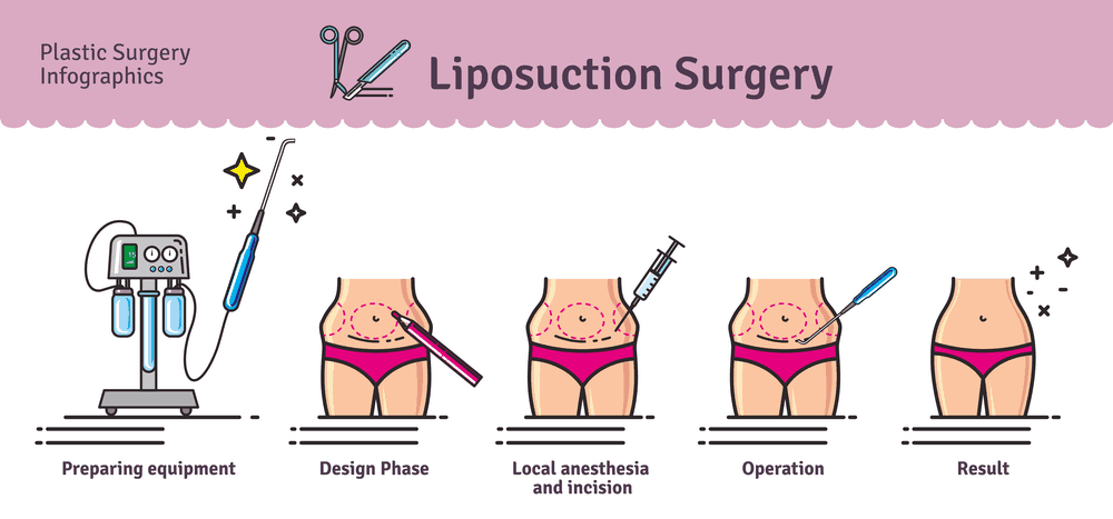 Liposuction Cost Total Prices List 2021 For Full Body Chin Neck Stomach Arm Thigh Belly