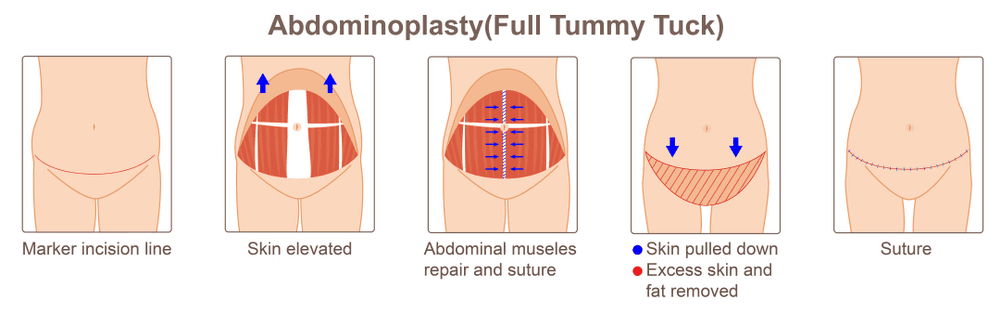 half tummy tuck cost