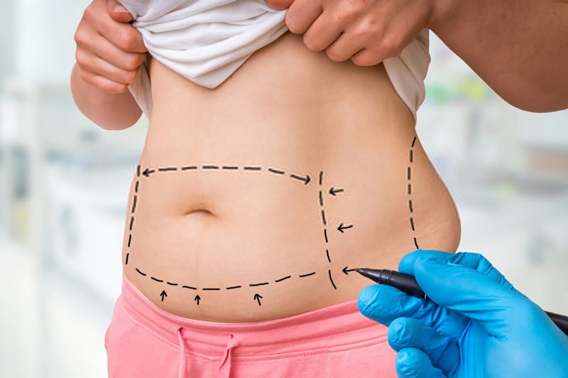 cost of mini tummy tuck with lipo