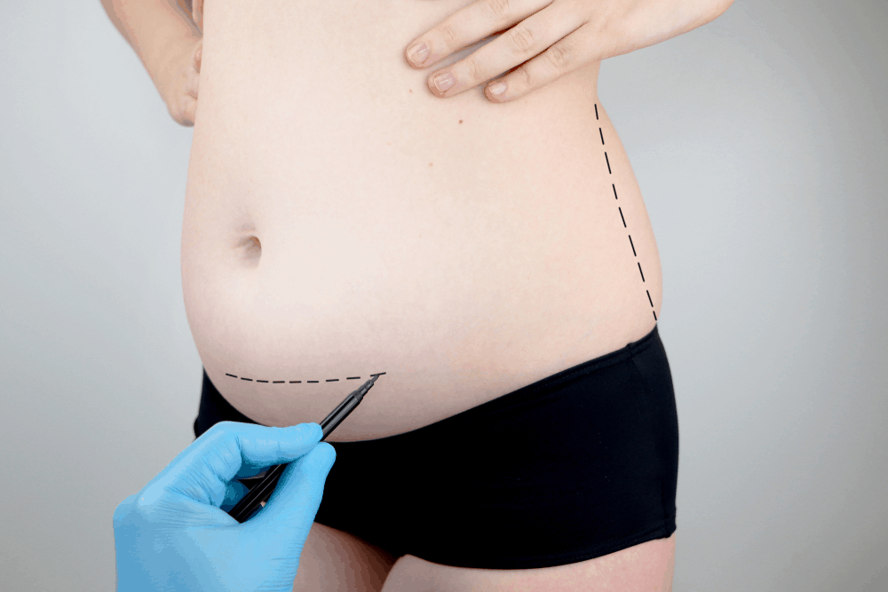 cost of mini tummy tuck with lipo