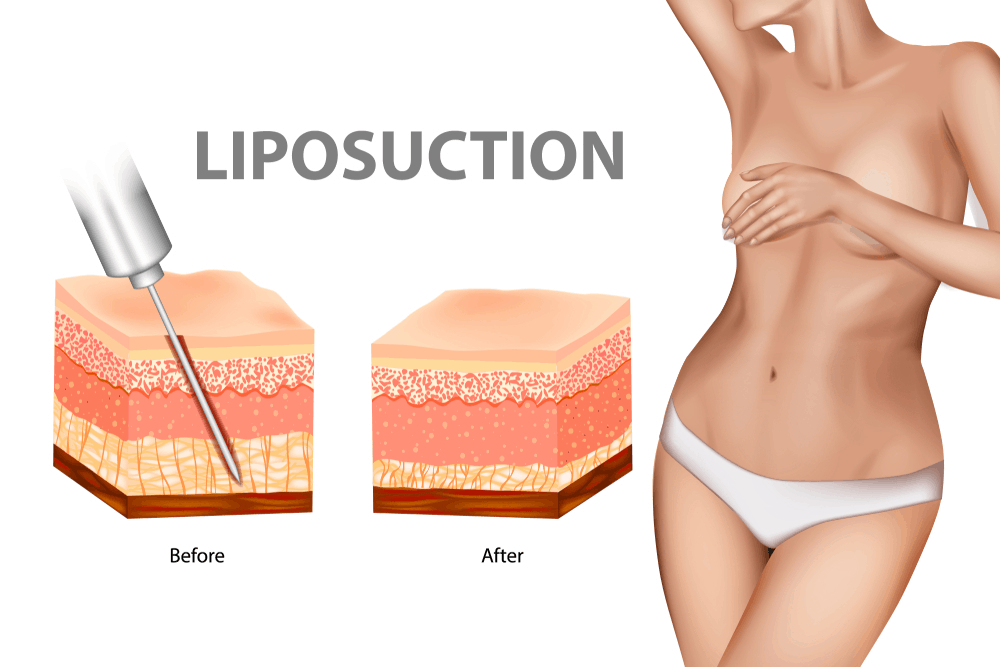 Liposuction Nyc