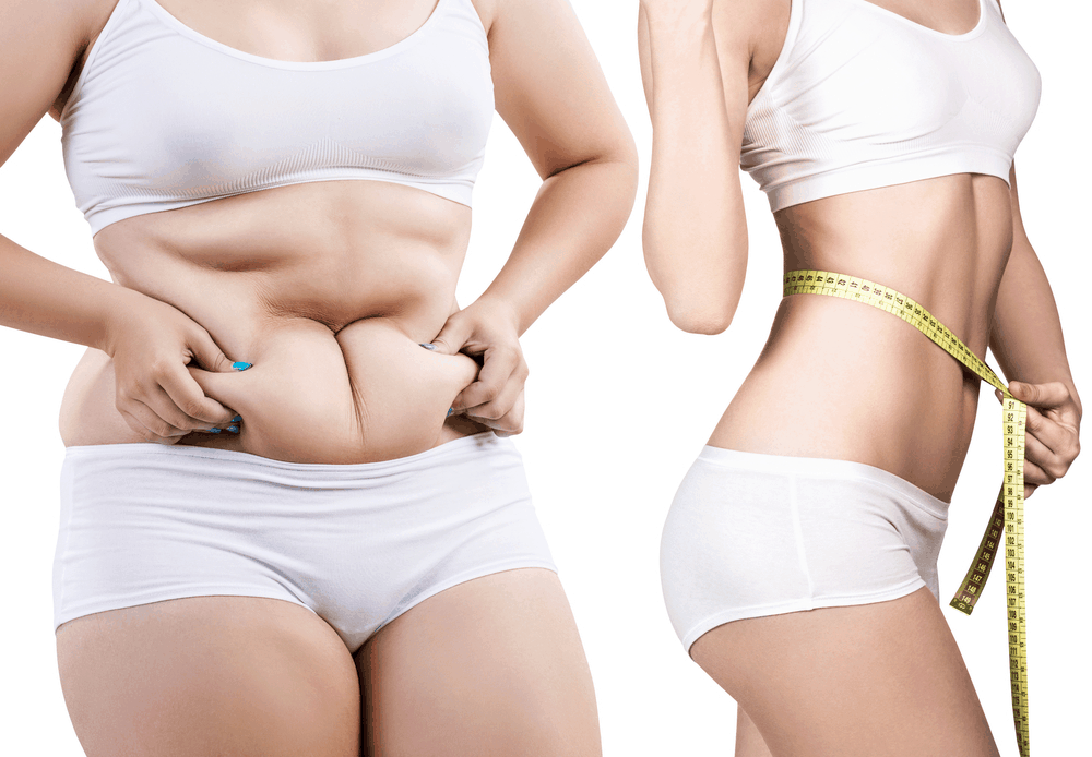 Liposuction Tampa