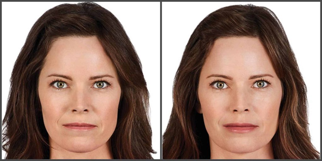 Juvederm Prices List 2024 Juvederm Cost Guide & Review