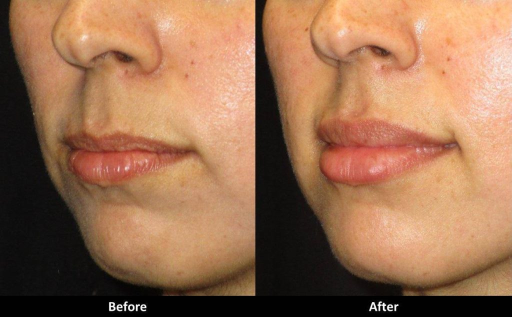 Juvederm Prices List 2024 Juvederm Cost Guide & Review