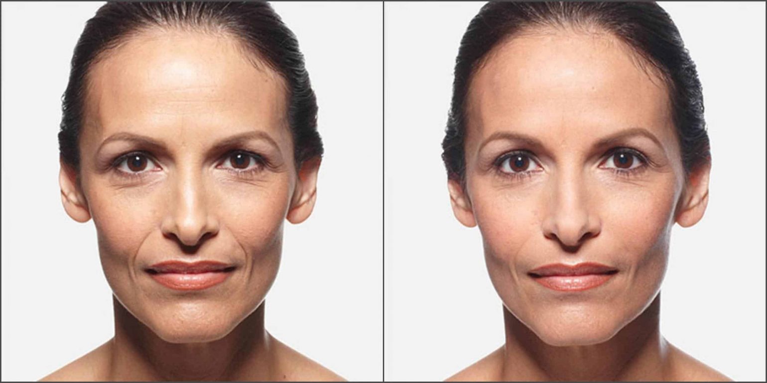 Juvederm Under Eye Filler Before After Worth The Cost Find Out - eym7sop