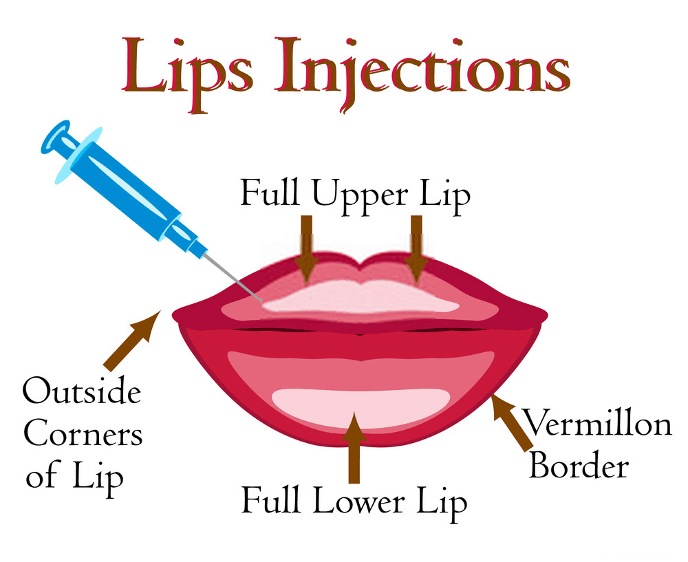 Lips injection cost