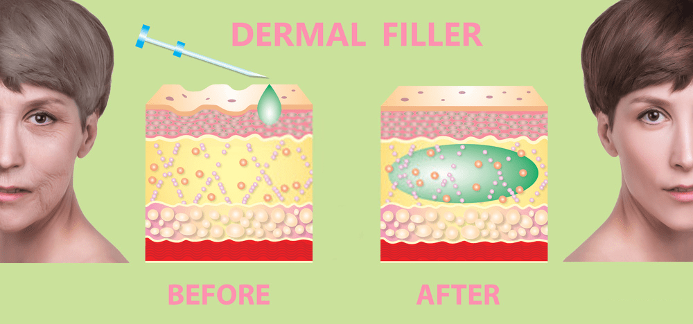 Bellafill Dermal Filler